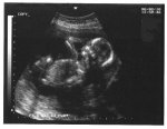 Ultrasound of Luke